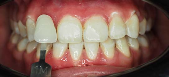 aft-air-polisher-1-img