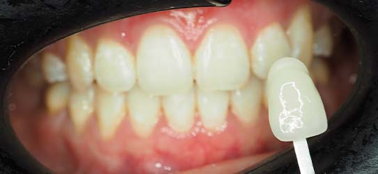 aft-air-polisher-3-img