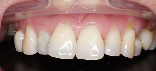 aft-bleaching-3-img
