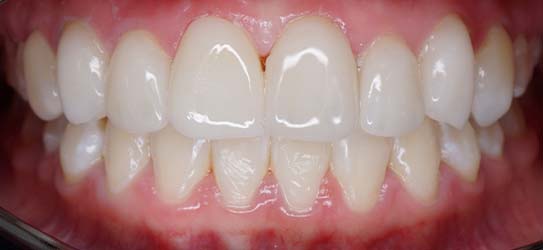 aft-veneers-1-img