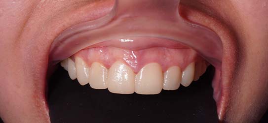 aft-veneers-2-img