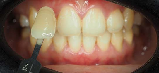 bef-air-polisher-3-img