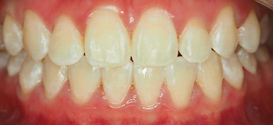 bef-veneers-1-img