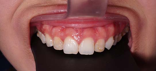 bef-veneers-2-img