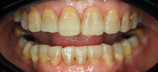 bef-veneers-3-img