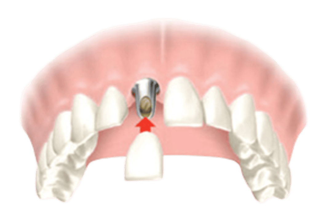 dental-implant-graphic