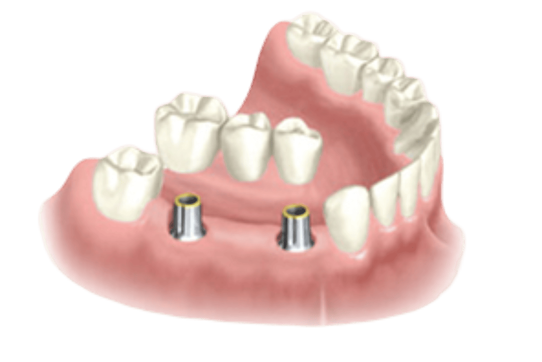 dental-implant-graphic