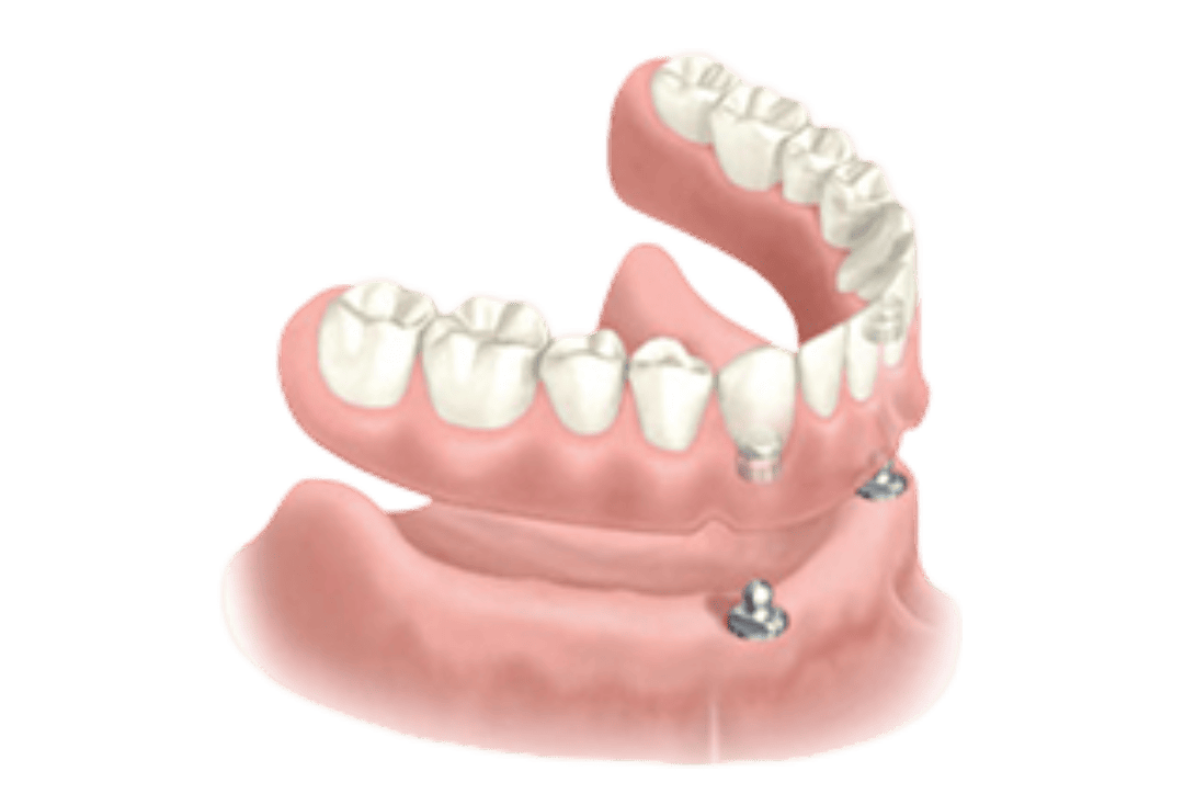 dental-implant-graphic