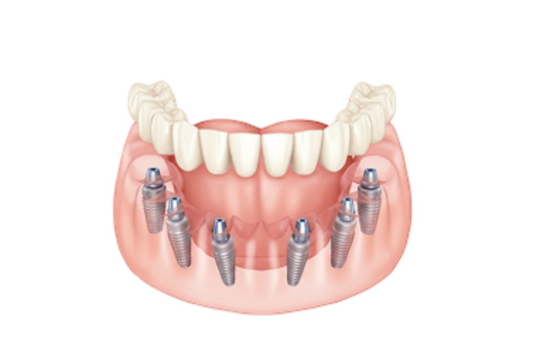 dental-implant-graphic
