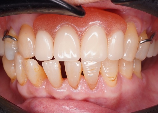 cloesup-teeth-before-filling-icon