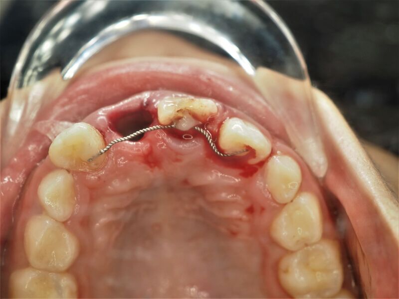 knocked-out-tooth