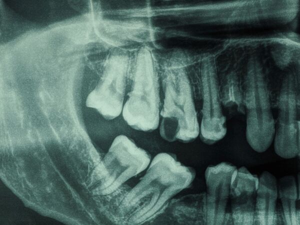 xrays